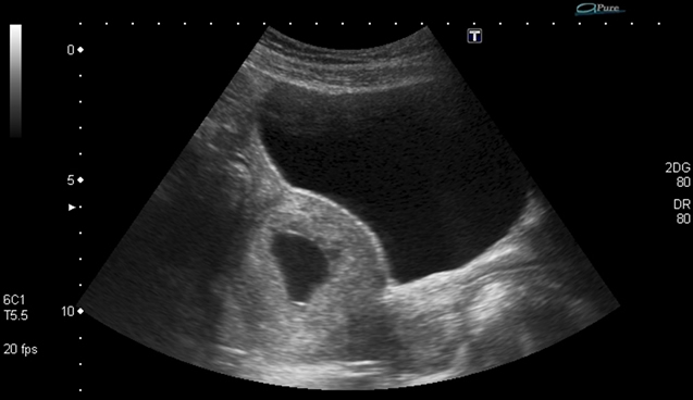rectouterine pouch ultrasound