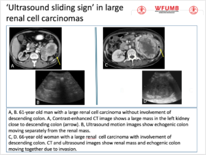 Ultrasound the Best #02: ‘Ultrasound sliding sign’ in large renal cell carcinomas