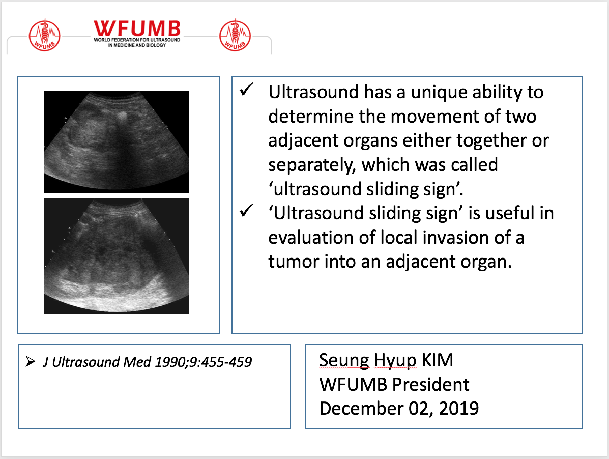 Ultrasound the Best 02 ‘Ultrasound sliding sign’ in large renal cell