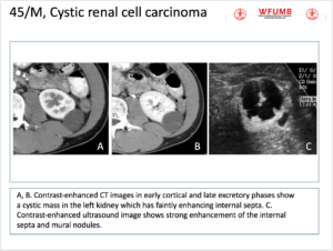 Ultrasound the Best #03: 45/M, Cystic renal cell carcinoma