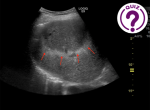 Case of the Month March 2020- The Northern Lights CEUS Artifact