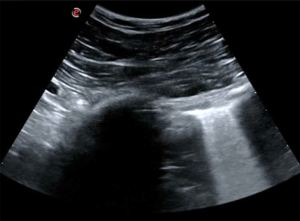 Case of the Month April 2020- Ultrasound findings in COVID-19 pneumonia