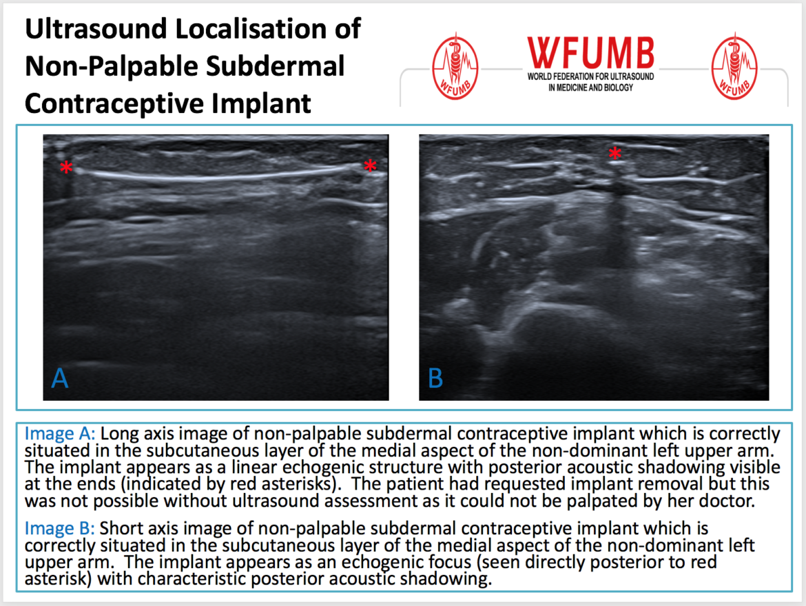 implantation-ultrasound