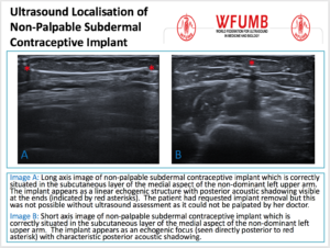 Ultrasound the Best #04: Ultrasound Localisation of  Non-Palpable Subdermal Contraceptive Implant