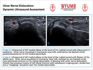 Ultrasound the Best #05: Ulnar Nerve Dislocation:  Dynamic Ultrasound Assessment