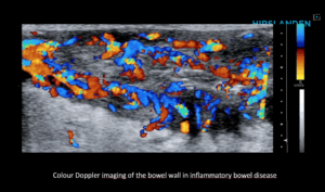 Ultrasound the Best #06: Colour Doppler imaging of the bowel wall in inflammatory bowel disease