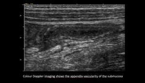 Ultrasound the Best #07: Colour Doppler imaging shows the appendix vascularity of the submucosa