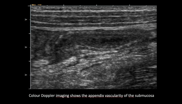 Ultrasound the Best #06: Colour Doppler imaging of the bowel wall in ...