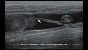 Ultrasound the Best #08: Appendix (in between markers) and mesappendix (arrow)
