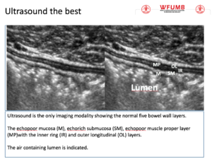 Ultrasound the Best #09: Ultrasound is the only imaging modality showing the normal five bowel wall layers.