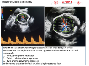 Ultrasound the Best #10: Doppler of the Fetal Middle of the Cerebral Artery