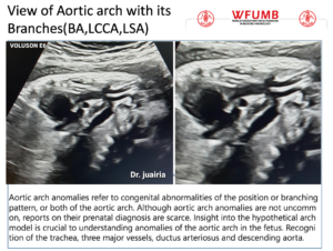 Ultrasound the Best #13: View of Aortic arch with its Branches (BA,LCCA,LSA)