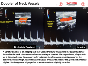 Ultrasound the Best #15: Doppler of Neck Vessels