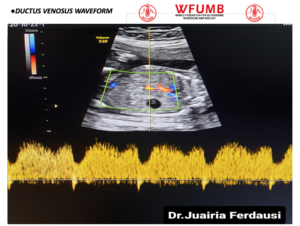 Ultrasound the Best #16: Ductus Venosus Waveform