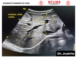 Ultrasound the Best #17: Segments of Liver