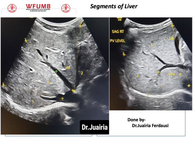 Ultrasound the Best #17: Segments of Liver – WFUMB