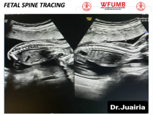 Ultrasound the Best #18: Fetal Spine Tracing