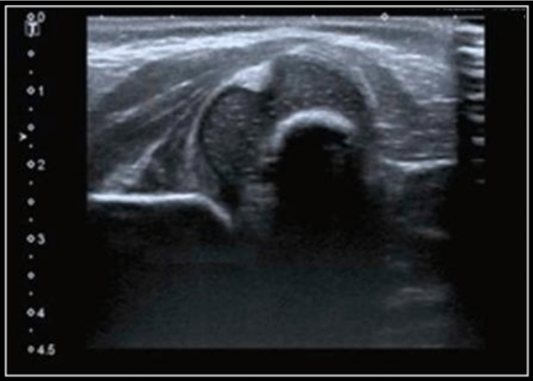 breech presentation hip ultrasound aap