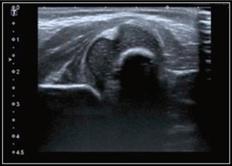 breech presentation ultrasound hip