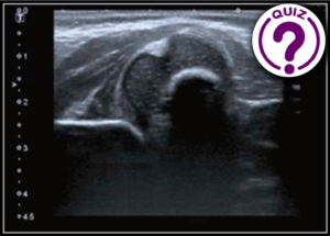 Case of the Month January 2021- Ultrasound of an infant hip after breech presentation