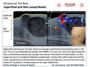 Ultrasound the Best #20: Superficial and Skin Lumps/Nodes