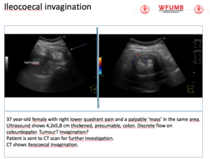 Ultrasound the Best #21: Ileocoecal Invagination