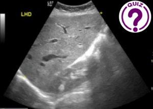 Case of the Month March 2021- A heart liver