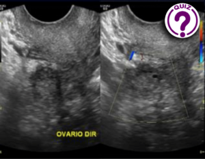 Case of the Month April 2021- A white sign on the ovary