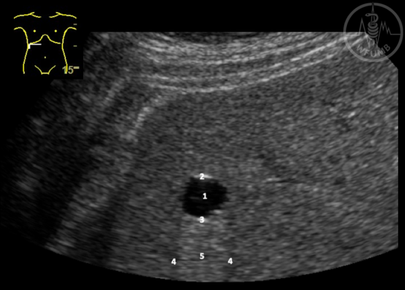 Focal Liver Lesions – Chapter 13.2 Media Library – WFUMB