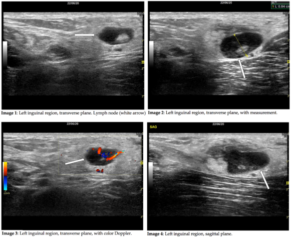 Case of the Month July 2021- Palpable inguinal lymph nodes – WFUMB