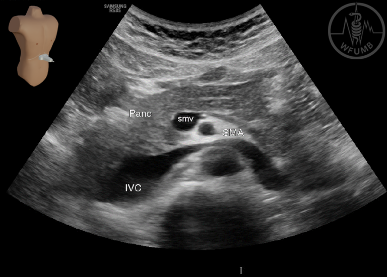 Abdominal Vessels and Portal Vein System Chapter 11 Media Library – WFUMB