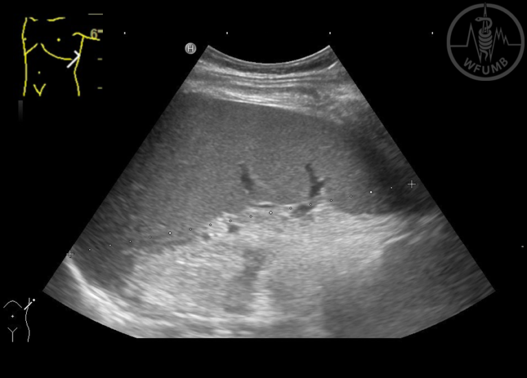 Spleen and Lymph Nodes Chapter 16 Media Library WFUMB
