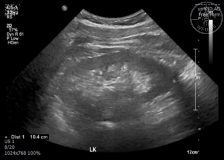 Ultrasound of the Kidneys and Adrenal glands – Chapter 17 Media Library ...