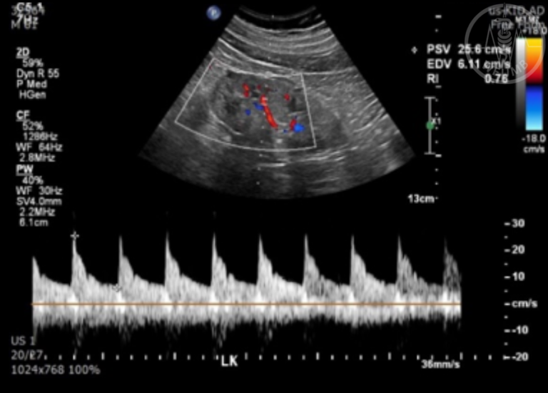 Ultrasound of the Kidneys and Adrenal glands – Chapter 17 Media Library ...