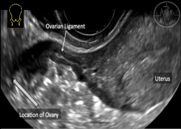 Basics in Gynecology – Chapter 20.2 Media Library – WFUMB