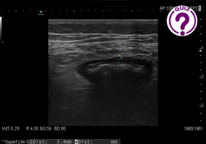 Case of the Month August 2021- Clinical picture vs imaging findings: an ultrasound surprise