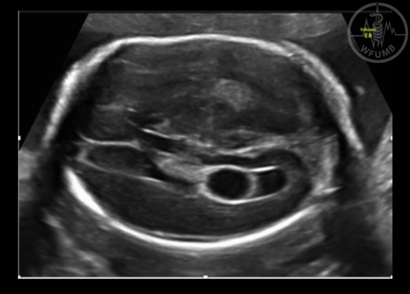 Basics Of Ultrasound In Obstetrics Chapter 201 Media Library Wfumb 6532