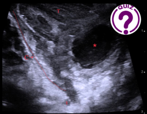 Case of the Month November 2021- Transoral ultrasound in a 27-year-old female with acute throat pain