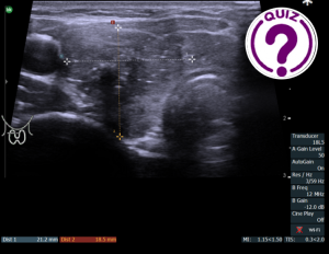 Case of the Month December 2021- Thyroid nodule in a young female with weight loss
