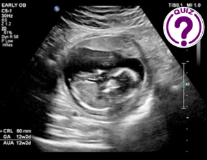 Case of the Month February 2022 - Intrauterine pregnancy, or is it?