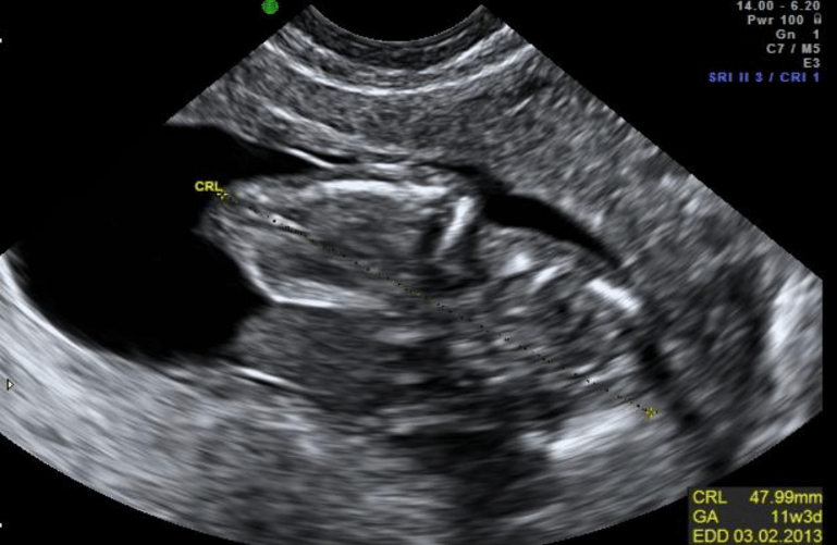 Tulege Tun Madova Xxx Vidos - Case of the Month November 2022 [2] â€“ The twelve week pregnancy scan â€“ WFUMB