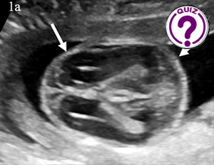 Case of the Month November 2022 [1] - Fetal skeletal abnormalities