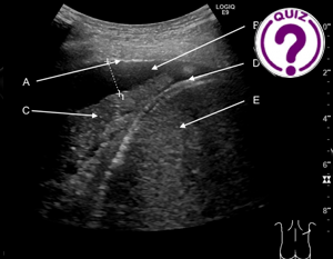 Case of the Month April 2023 - Ultrasound-guided pleural effusion drainage