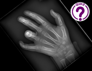Case of the Month March 2023 - Suspected finger fracture