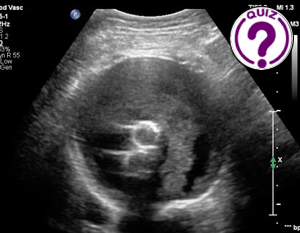 Case of the Month September 2023 - Flow in a AAA sac following EVAR. Is it an endoleak?