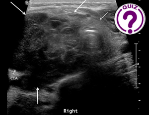 Case of the Month December 2023 - Thyroid case
