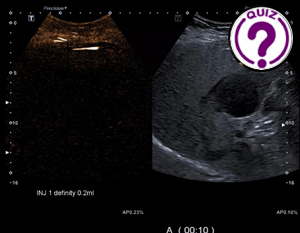 Case of the Month November 2023 - Liver lesions in a patient with fatty liver