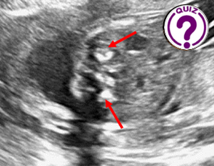 Case of the Month April 2024 - Bilateral fetal adrenal calcifications