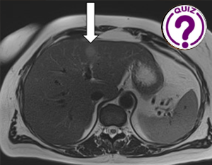 Case of the Month March 2024 (2) - An uncommon focal liver lesion