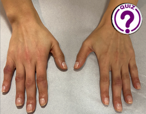 Case of the Month March 2024 - Ultrasound as an auxiliary tool in the diagnosis of dermato-rheumatological conditions